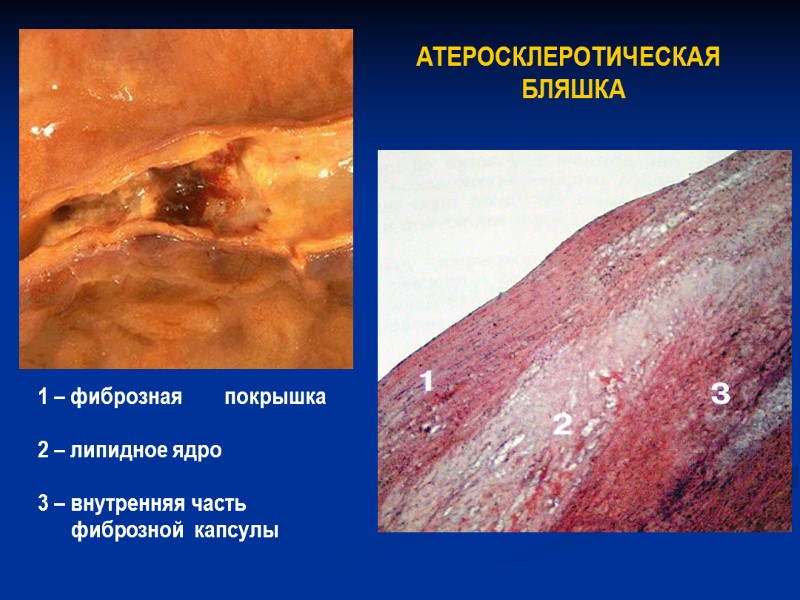 АТЕРОСКЛЕРОТИЧЕСКАЯ  БЛЯШКА   1 – фиброзная      